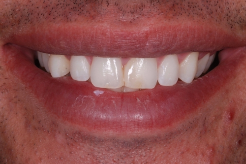 Composite veneers - Case 1 before