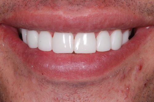 Composite veneers - Case 1 after