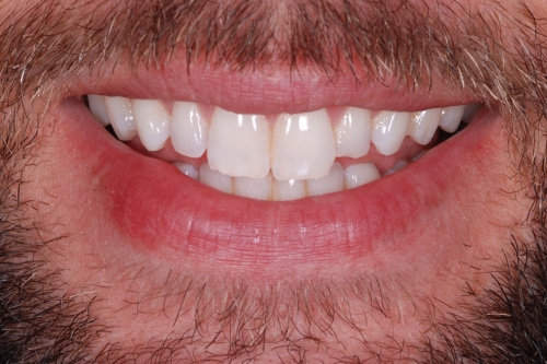 Composite veneers - Case 2 before