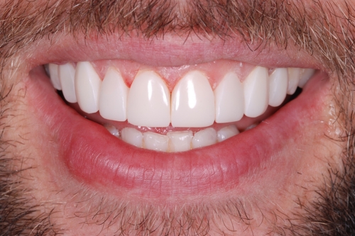 Composite veneers - Case 2 after
