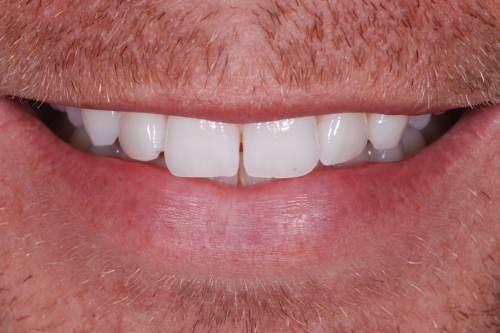 Composite veneers - Case 3 before