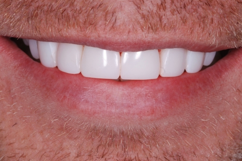 Composite veneers - Case 3 after
