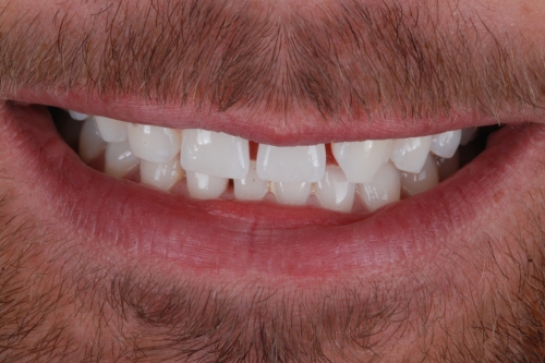 Composite veneers - Case 4 before