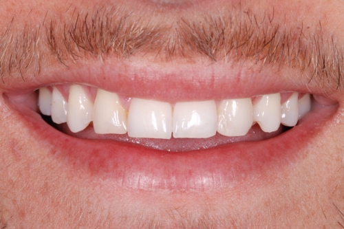 Composite veneers - Case 5 before