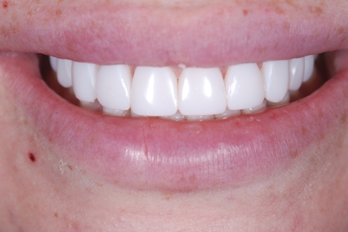 Composite veneers - Case 6 after