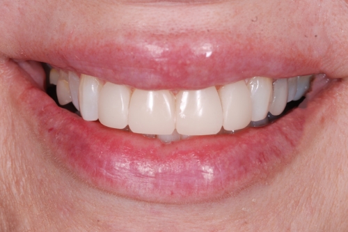 Composite veneers - Case 7 after