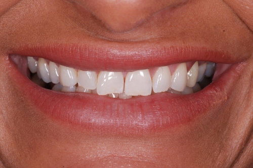Composite veneers - Case 8 before