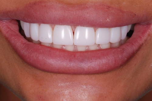 Composite veneers - Case 9 after