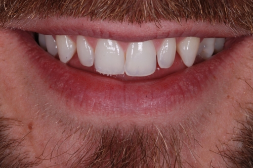 Composite veneers - Case 10 before