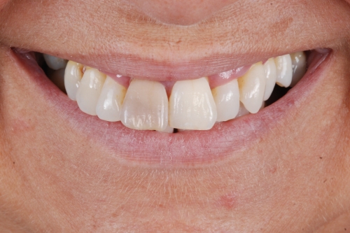 Bridges - Case 1 before