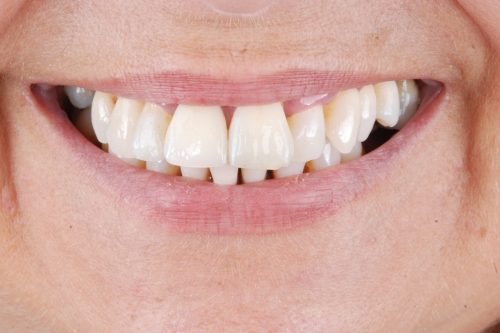 Bridges - Case 1 after