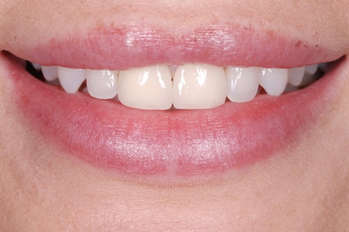 Crowns - Case 1 before