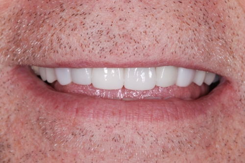 Crowns - Case 2 after