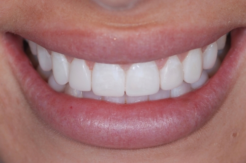 Edge bonding - Case 1 after