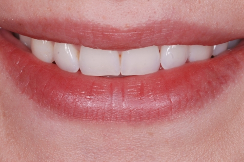 Edge bonding - Case 2 before