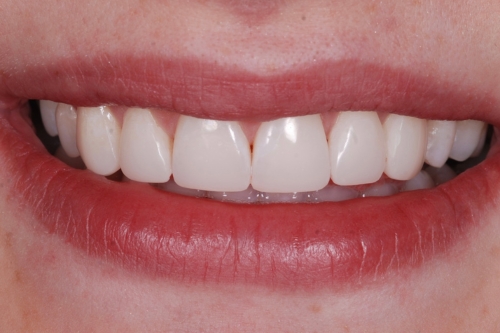 Edge bonding - Case 2 after