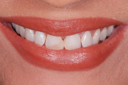 Edge bonding - Case 3 before