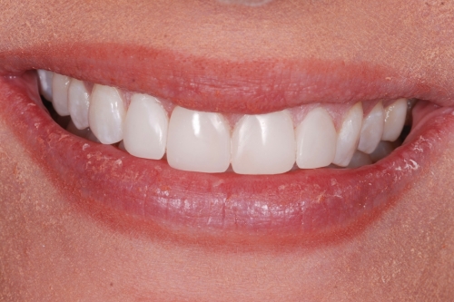 Edge bonding - Case 3 after