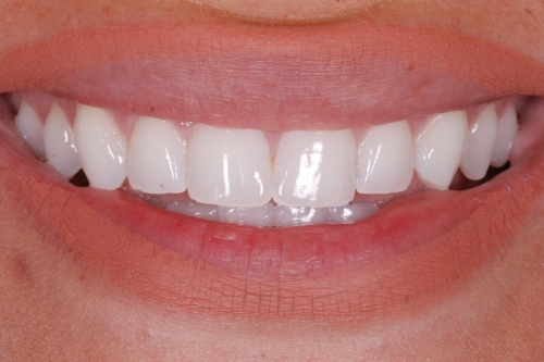 Edge bonding - Case 4 before