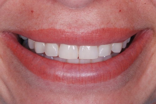 Edge bonding - Case 5 before