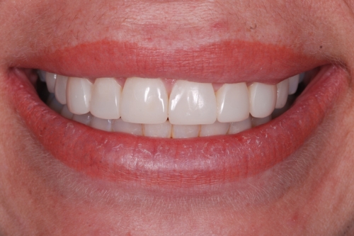 Edge bonding - Case 5 after