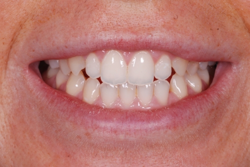 Invisalign rejuvenate package - Case 2 before