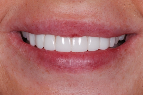 Invisalign rejuvenate package - Case 2 after