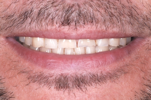Invisalign rejuvenate package - Case 3 before