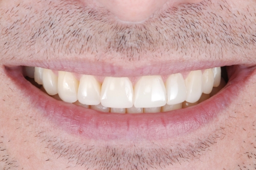 Invisalign rejuvenate package - Case 3 after