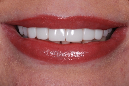 Invisalign rejuvenate package - Case 4 after