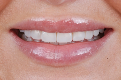 Invisalign enhance package - Case 1 after