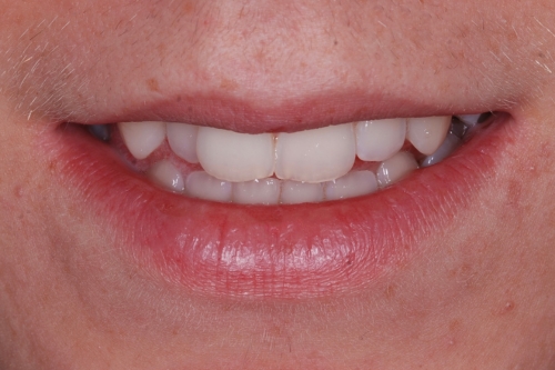 Invisalign enhance package - Case 2 before