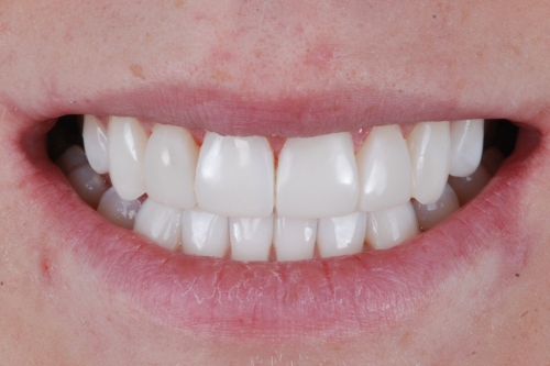 Invisalign enhance package - Case 2 after