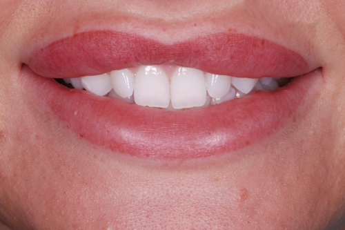Invisalign enhance package - Case 3 before