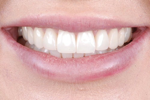 Invisalign enhance package - Case 4 after