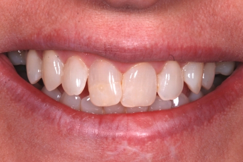 Invisalign enhance package – Case 6 before