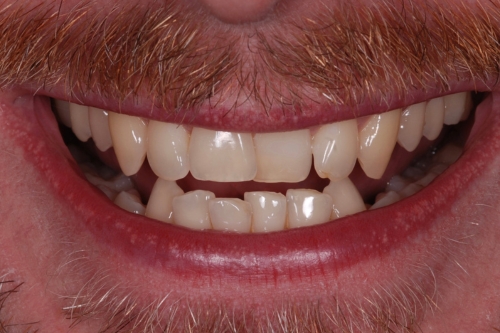 Invisalign enhance package – Case 7 before