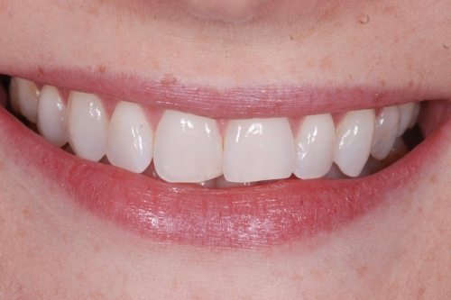 Invisalign enhance package – Case 9 before