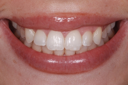 Invisalign enhance package – Case 10 before