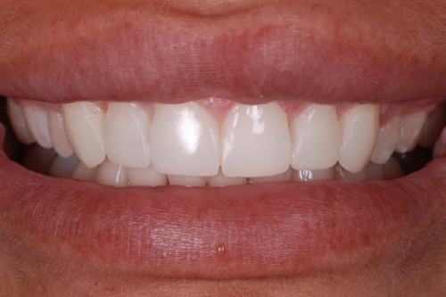 Invisalign enhance package – Case 11 after
